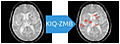 KI-Basierte Quantifizierung Zerebraler Mikroblutungen in Magnet-Resonanz-Tomographie-Aufnahmen des Gehirns - KIQ-ZMB